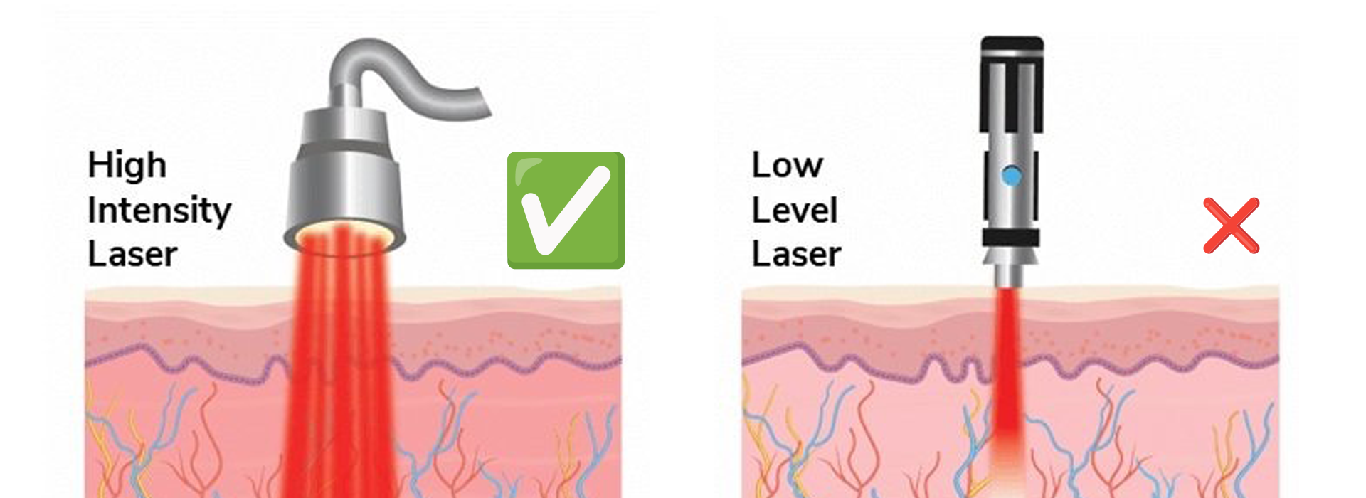High power laser therapy vs low level laser